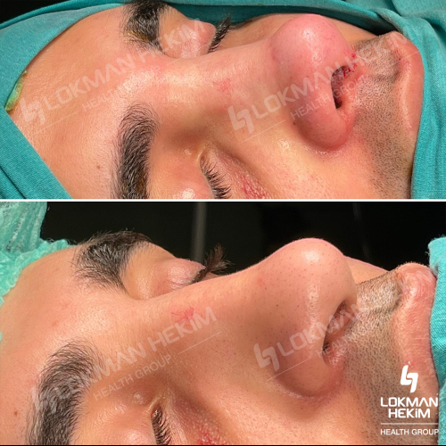 Rinoplastia (con injerto) Foto antes/después